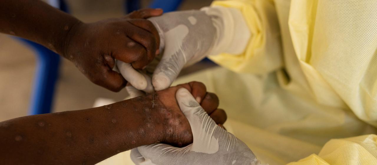 Eine Krankenschwester begutachtet die Arme eines Kindes im Kongo