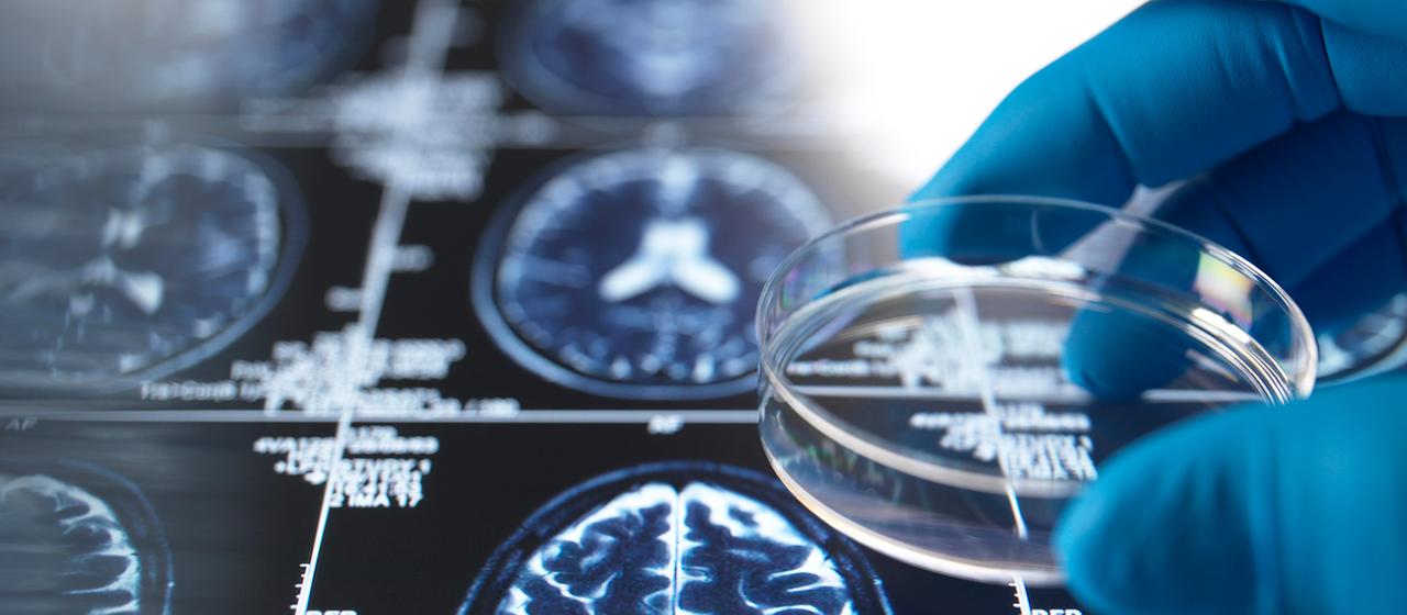 Eine Hand in einem Handschuh hält eine Petrischale über einem MRT-Scan des Gehirns für die Alzheimer-Forschung.