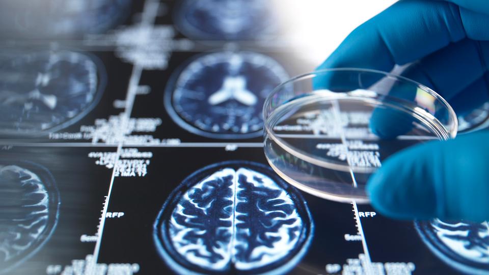 Eine Hand in einem Handschuh hält eine Petrischale über einem MRT-Scan des Gehirns für die Alzheimer-Forschung.