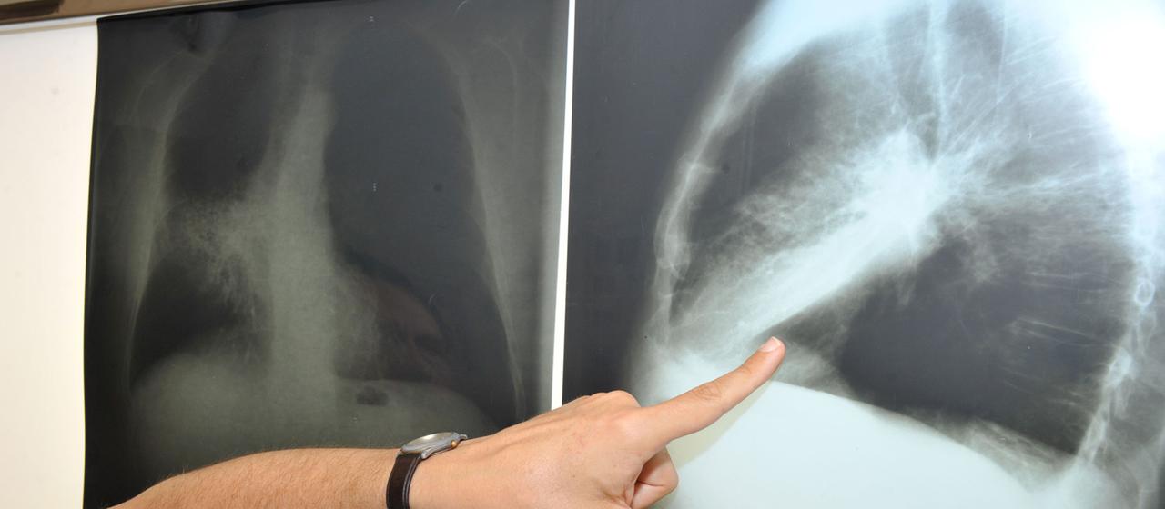 Ein Arzt zeigt auf ein Röntgenbild einer von Krebs befallenen Lunge.