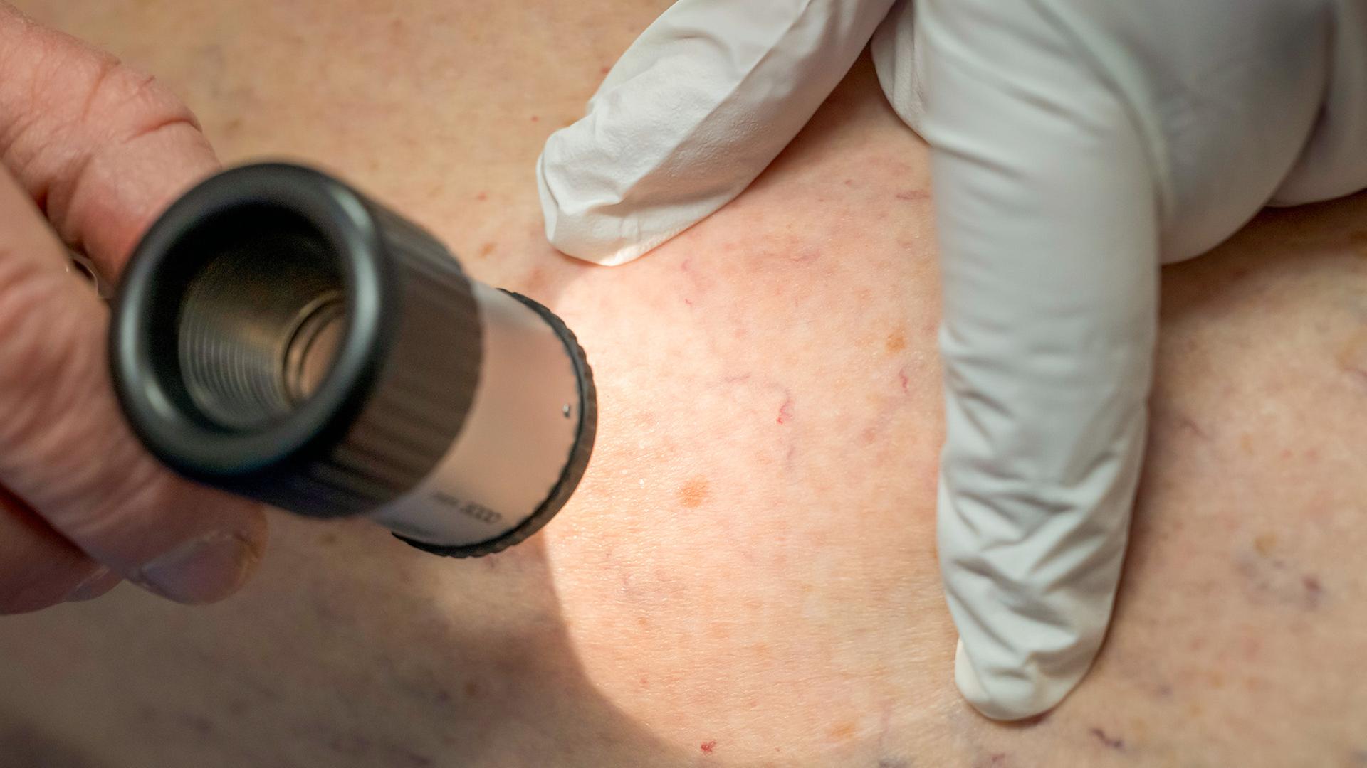 Hoffnung auf Impfstoff gegen schwarzen Hautkrebs
