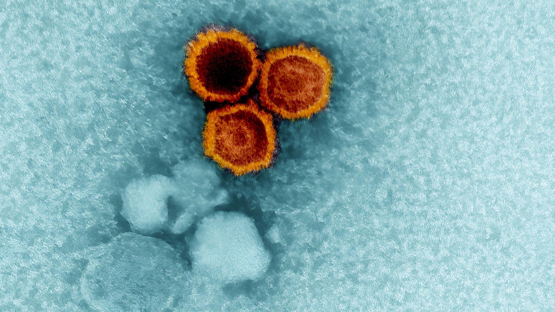 Studie: Wie ein Virus Multiple Sklerose mitauslösen kann Studie: Wie ein Virus Multiple Sklerose mitauslösen kann