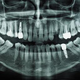 Orthopantomogramm von Unterkiefer, Oberkiefer und Zähnen