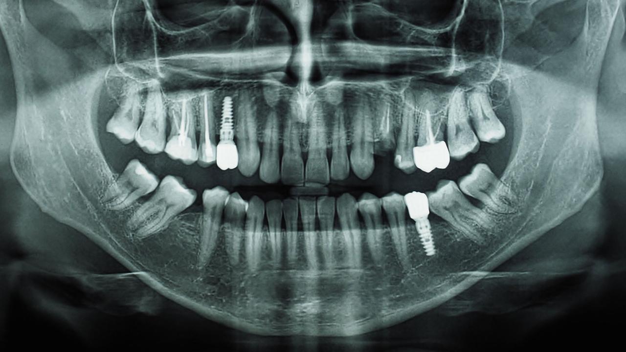 Lohnt sich die Zahnzusatzversicherung wirklich?