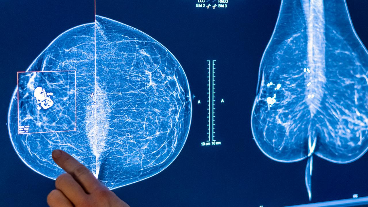 Bessere Krebsdiagnose und -therapie dank KI