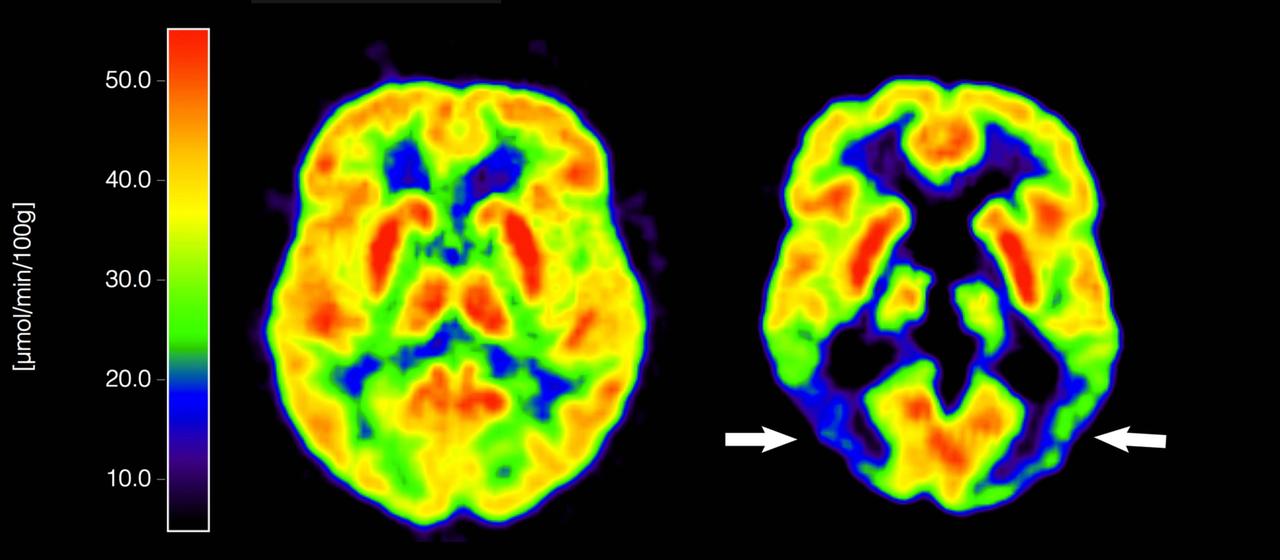 Die mit der Positronen-Emissions-Tomografie (PET) erstellte Abbildung zeigt die Gegenüberstellung zweier Gehirne - im gesunden Zustand und mit Alzheimer-Krankheit. (Archivbild: 05.02.2012)