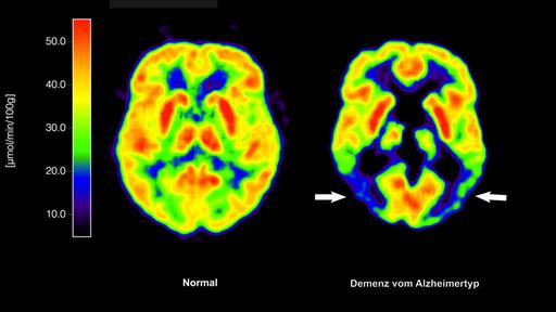 Vorbeugung von Demenz durch Gesundheitsdaten