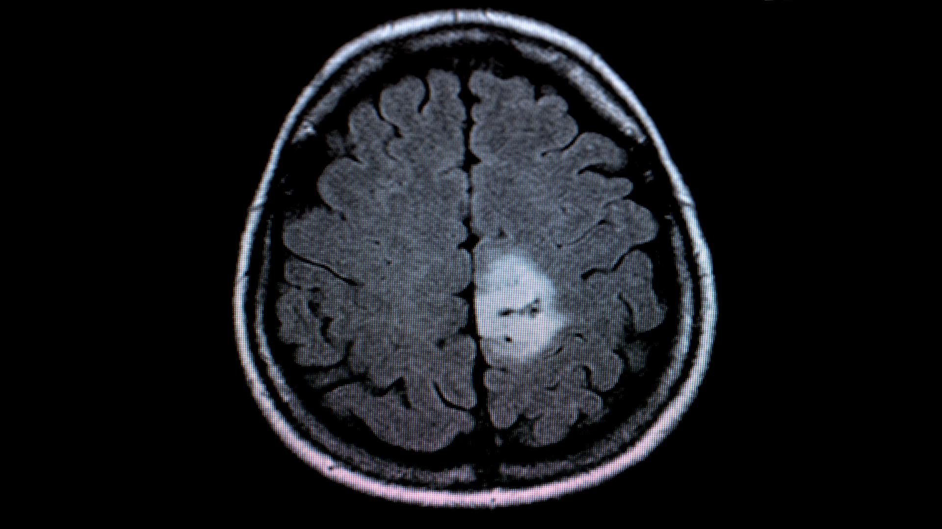 Das MRT-Bild des Gehirntumors (heller Fleck) | picture alliance / dpa