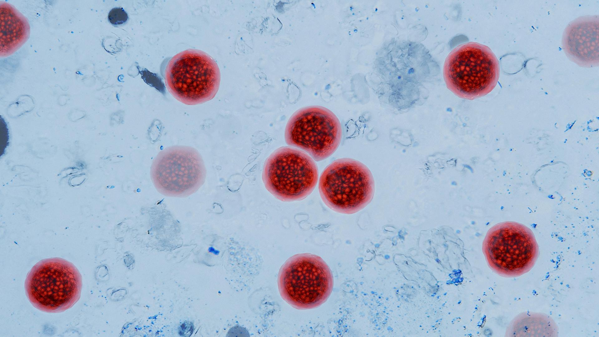 Cyclospora-Parasit: Mehr als 10.000 Durchfall-Fälle in den USA bestätigt