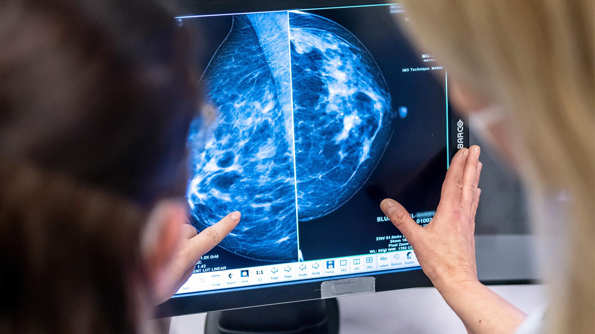 Ein Computerbildschirm mit einer Mammographie-Aufnahme