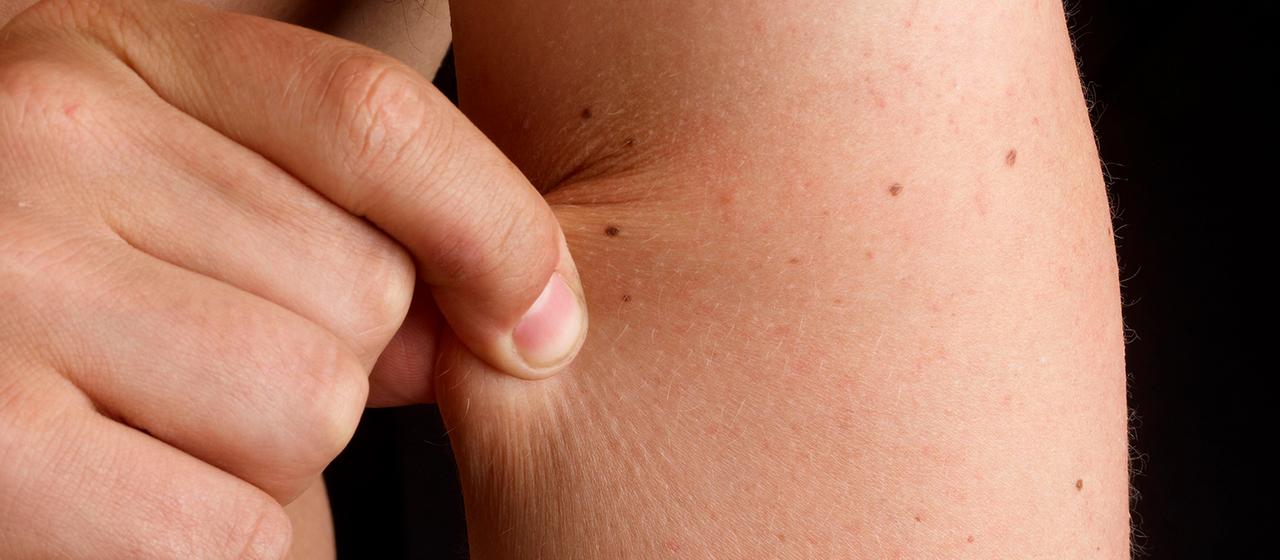 Die Haut an einem Oberarm wird mit Fingern zusammengekniffen.