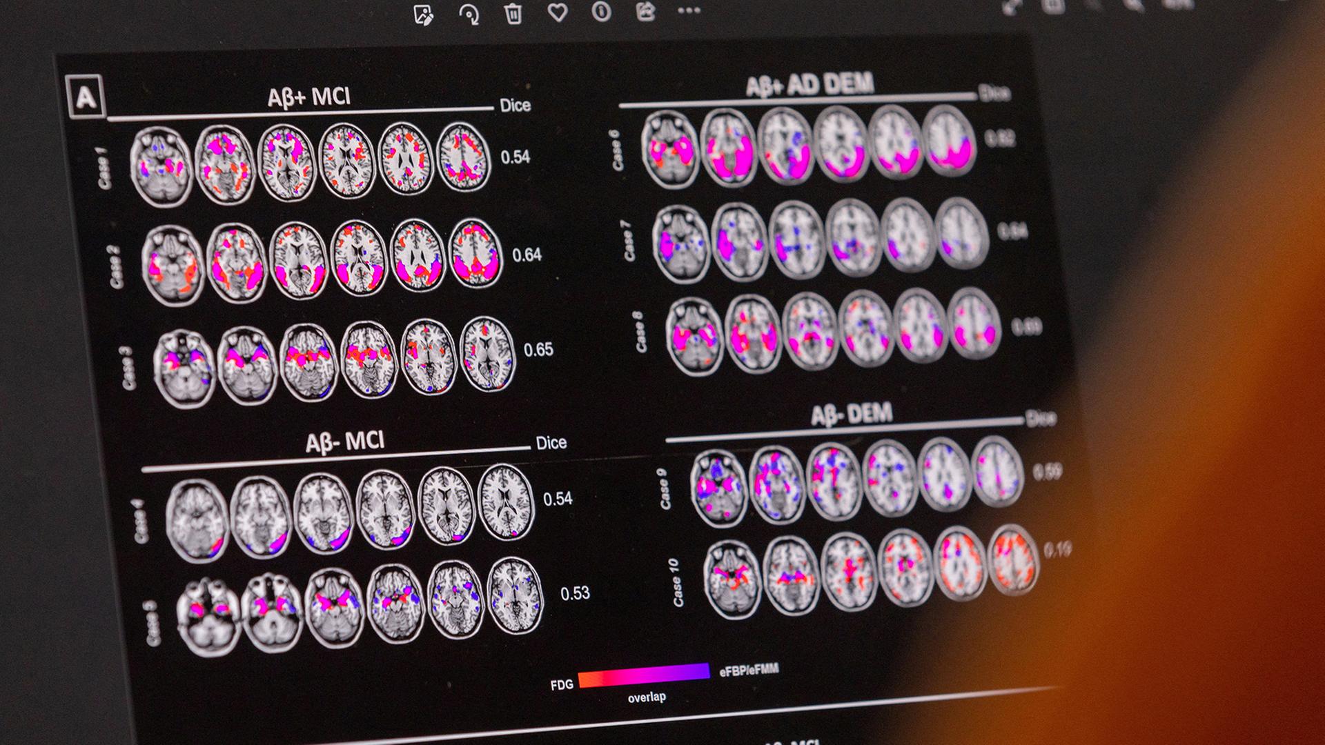 Ein Wissenschaftler betrachtet ein Gehirnscreening eines Patienten mit Alzheimer-Krankheit im Gedächtniszentrum der Abteilung für Readaptation und Geriatrie des Universitätsspitals (HUG) in Genf, Schweiz