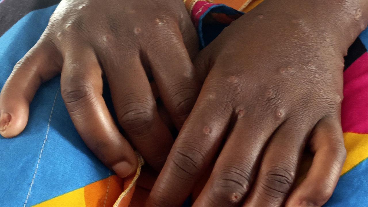 who-erkl-rt-internationale-notlage-wegen-mpox-f-r-beendet