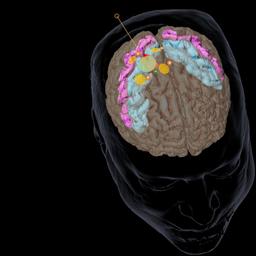 Positionierung der Stimulationselektrode